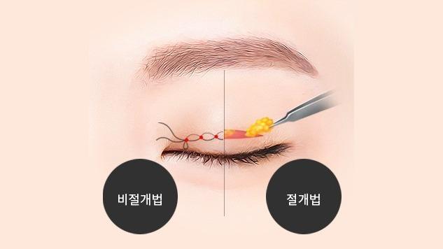 매듭 만들기 | 지방 및 근육 제거