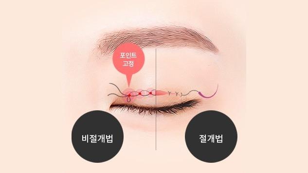 연속 묶음, 포인트 고정 | 미세 봉합