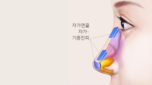 함몰 부위 개선
