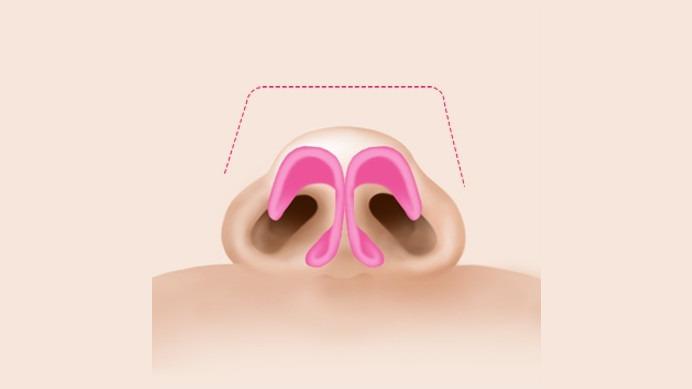 퍼진 상자 코끝