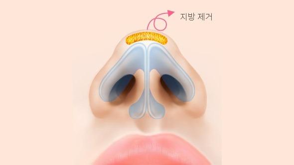 코끝 지방 제거