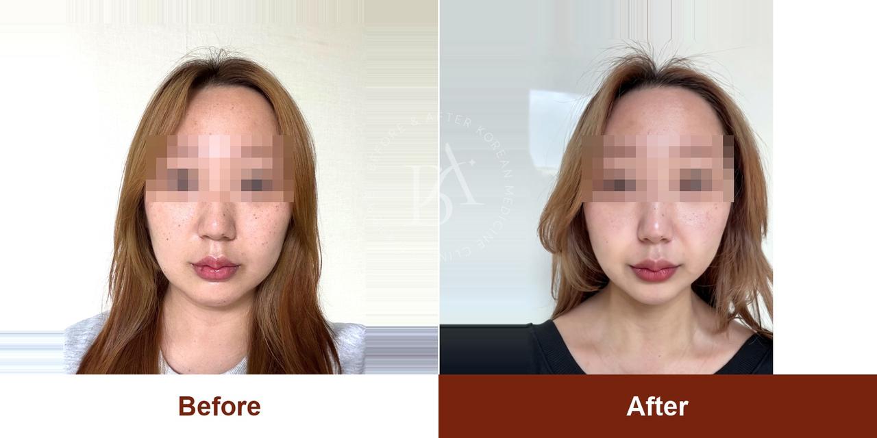 주근깨 레이저