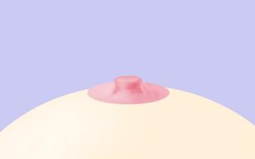 함몰유두 1단계