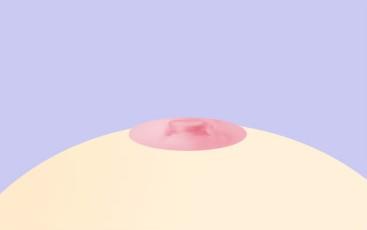 함몰유두 2단계