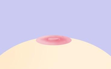함몰유두 3단계
