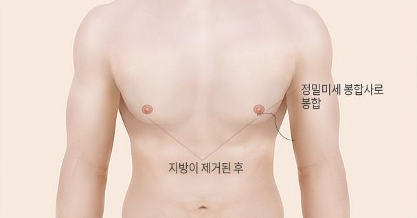 봉합