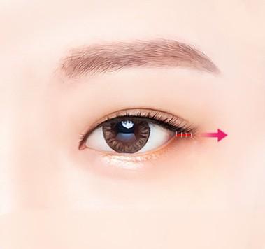 Delicate suturing