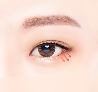 Delicate suturing