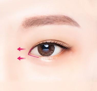 Delicate suturing
