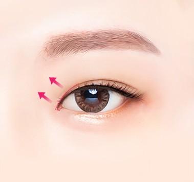 Delicate suturing