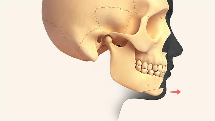 Receding chin (chin advancement)