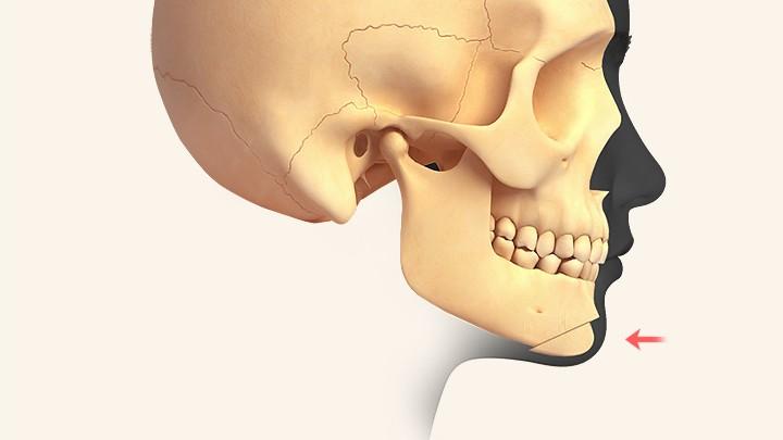 Underbite (chin setback)