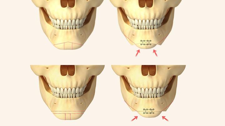 Various osteotomies depending on chin symptoms