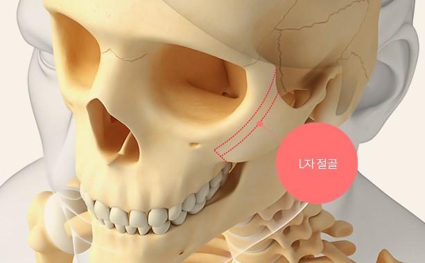 L 광대 절골
