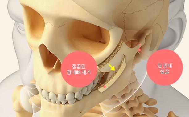 절골된 광대뼈 제거와 뒤쪽 광대 절골