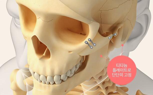 티타늄 플레이트로 단단하게 고정