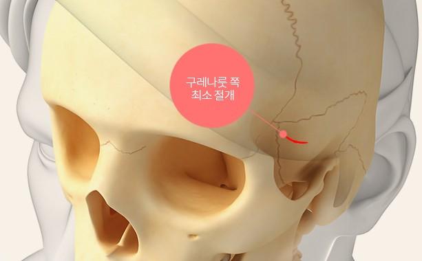 구레나룻 쪽 최소 절개