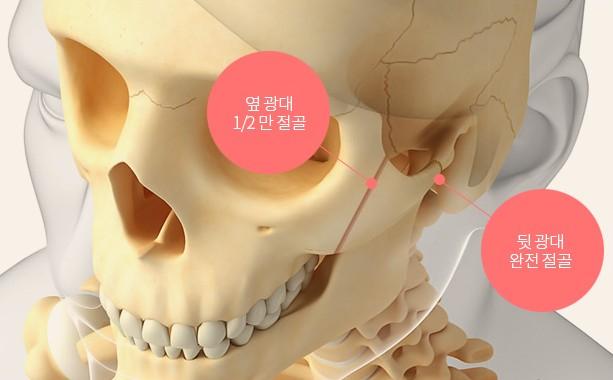 옆 광대, 뒷 광대 절골