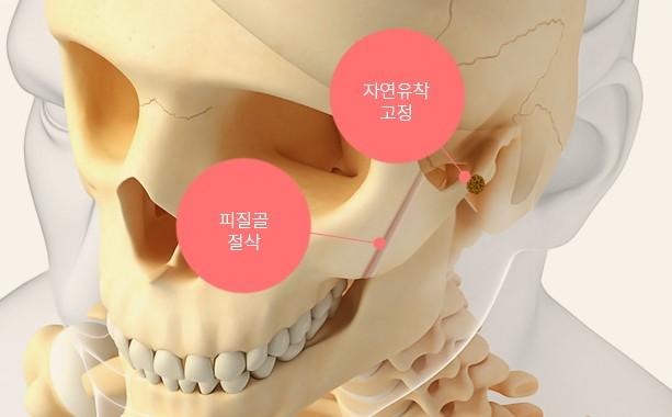 자연유착 또는 밀착 고정 & 피질골 절삭