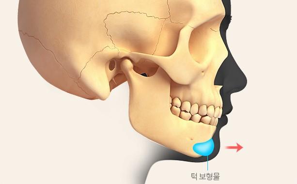 맞춤 보형물로 볼륨 개선