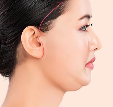 디자인 후 절개