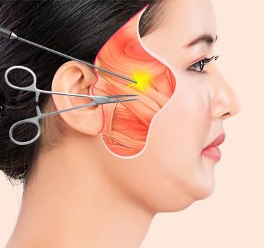 스마스층 박리, 유지인대 끊어주기