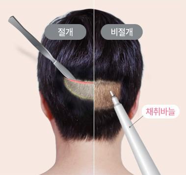 모낭 채취