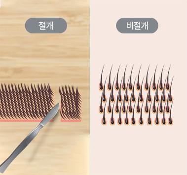 모낭 분리 및 조직 정리