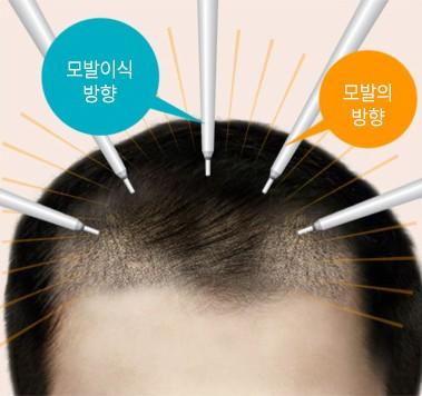 모낭 이식