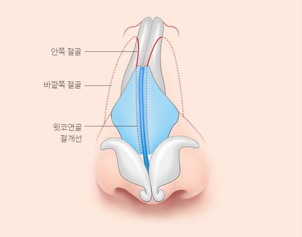 절골