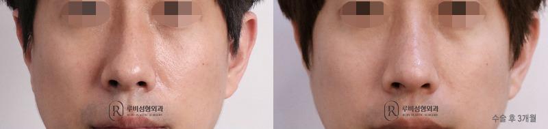 Men's nose surgery (nose bridge, nose tip, humpectomy)