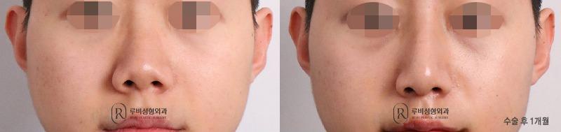 Men's nose surgery (nose bridge, nose tip, short nose correction, alar cinching)