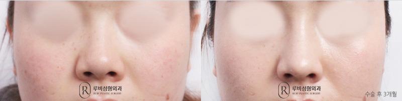 Nose Surgery