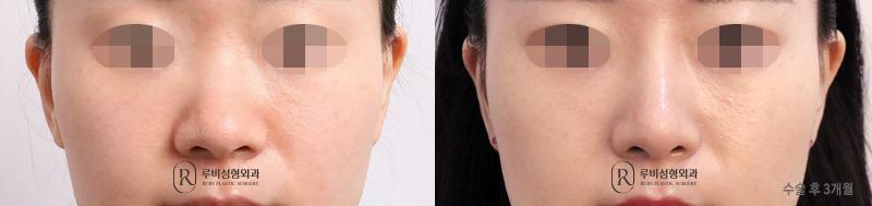 Nose surgery (nose bridge, nose tip, short nose correction, alar cinching)