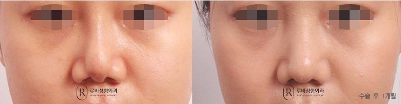 Nose Revision