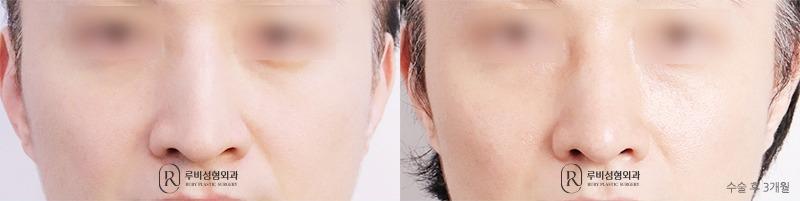 Nose surgery (nose bridge, nose tip, long nose correction)