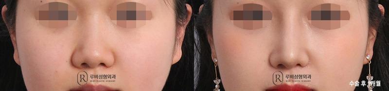 Nose surgery (nose bridge, nose tip, short nose correction)