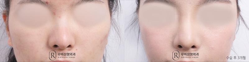 Nose Surgery