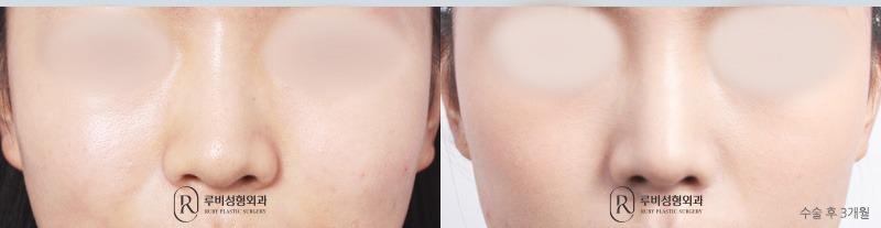 Nose Surgery