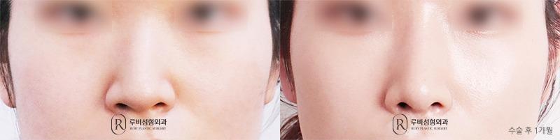 Nose surgery (nose bridge, nose tip, humpectomy, long nose correction)