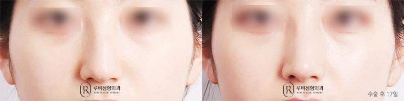 Nose surgery (nose bridge, nose tip, humpectomy, long nose correction)