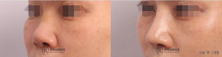 Nose Surgery