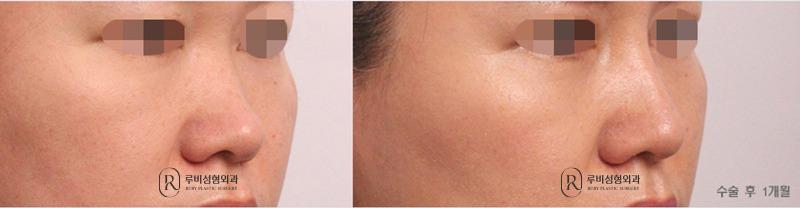 Nose Surgery