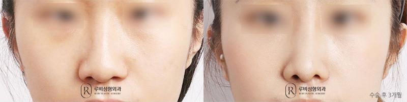 Nose surgery (nose bridge, nose tip, long nose correction)