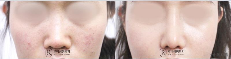 Nose Surgery