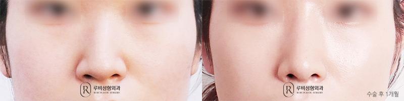 Nose surgery (nose bridge, nose tip, humpectomy, long nose correction)