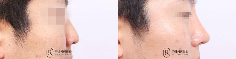Men's nose surgery