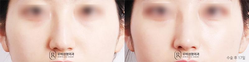 Nose surgery (nose bridge, nose tip, humpectomy, long nose correction)