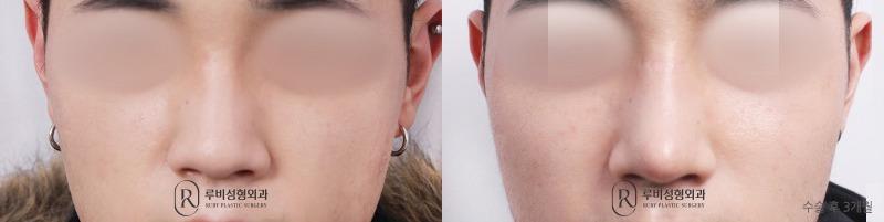 Men's nose surgery