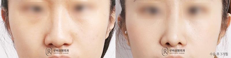 Nose surgery (nose bridge, nose tip, long nose correction)